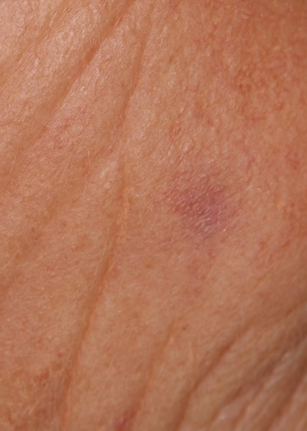 An angioma before and after one Clarity II treatment.