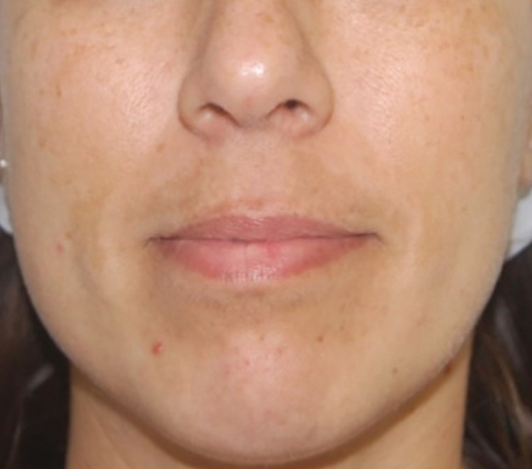 Uneven facial pigmentation before and after three Clarity II toning treatments.