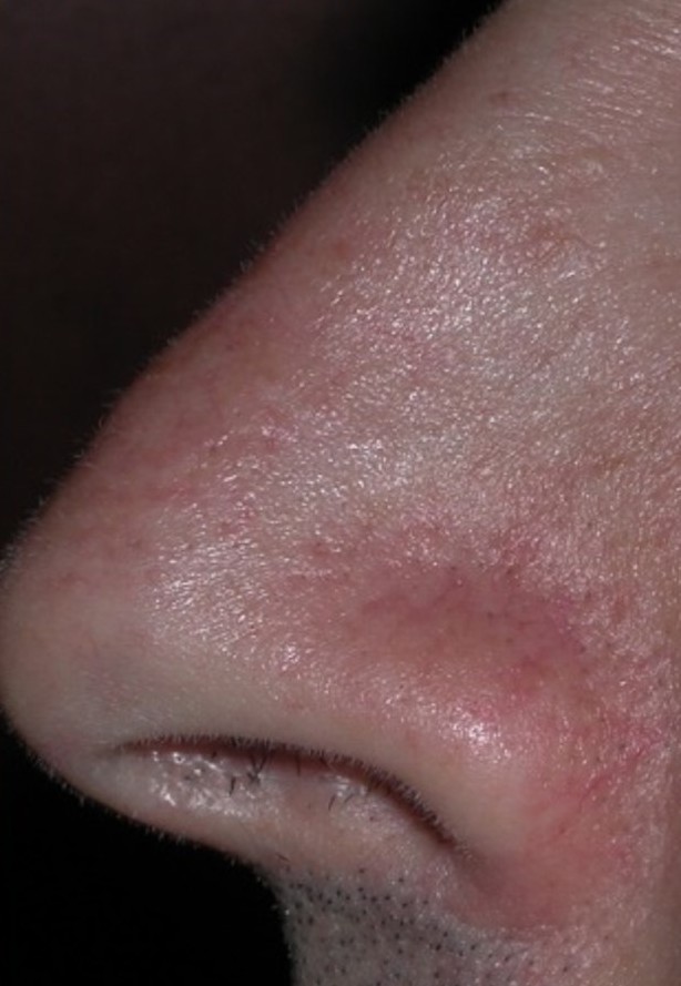 Visible capillaries on the nose before and after one Clarity II treatment.