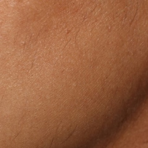 Fine hair before and after a course of laser hair removal with Clarity II.