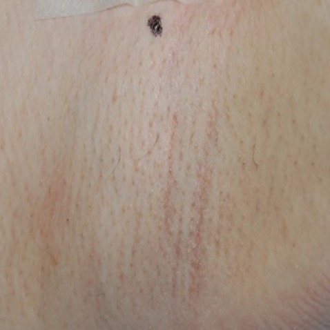 Skin before and after a course of laser hair removal with Clarity II.