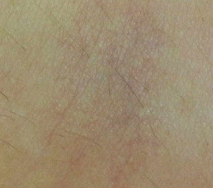 Fine spider veins on the leg before and after Clarity II treatment.