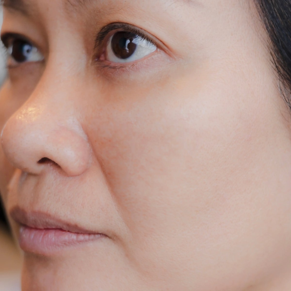 Brown spots and uneven tone on the cheek fade to clear, even skin.