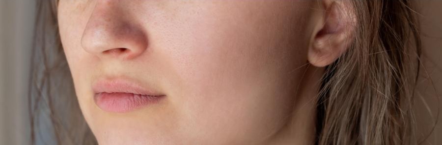 Red acne marks on the cheek and chin fade to calm, even skin.